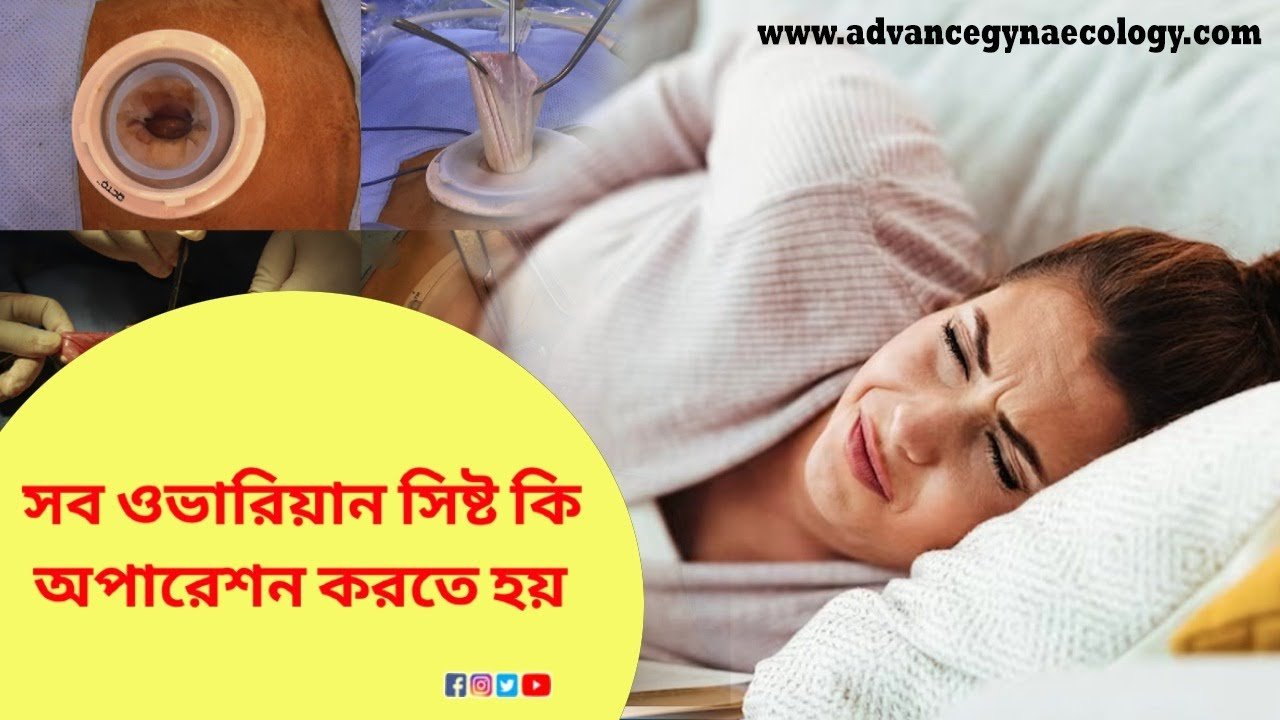 Myths & Facts about Ovarian Cysts